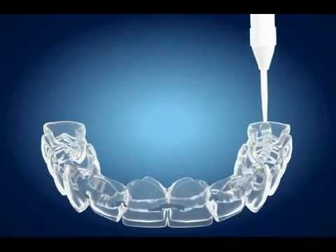 Înălbirea dinților - una dintre cele mai întrebate proceduri stomatologice