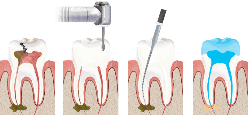 Tratament-endodontic-detaliat