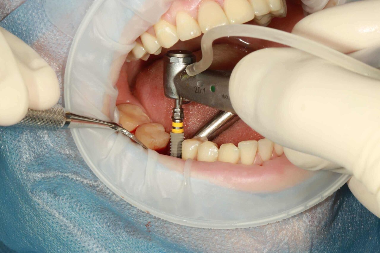 Affordable high-quality dental implants in Moldova, Chisinau