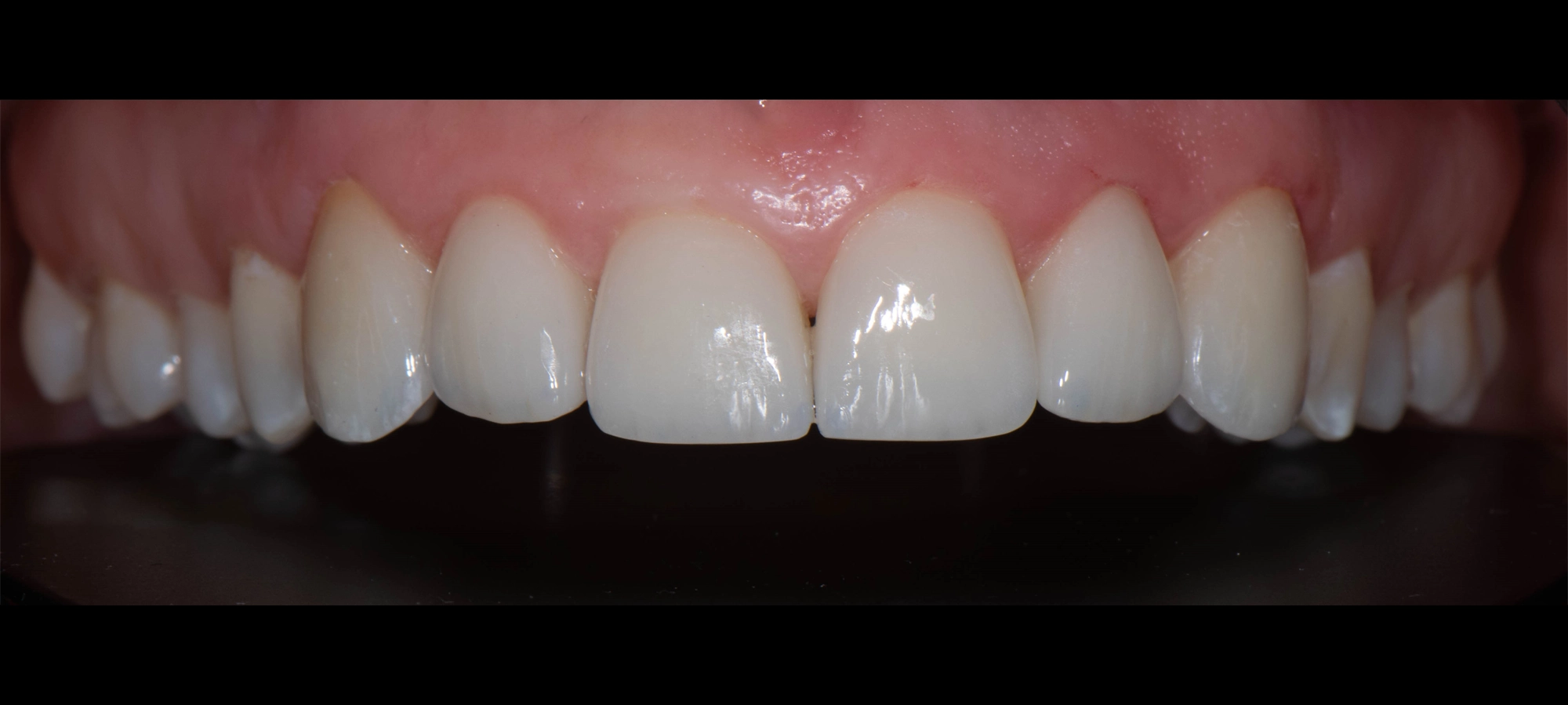 veneers after1 veneers after1