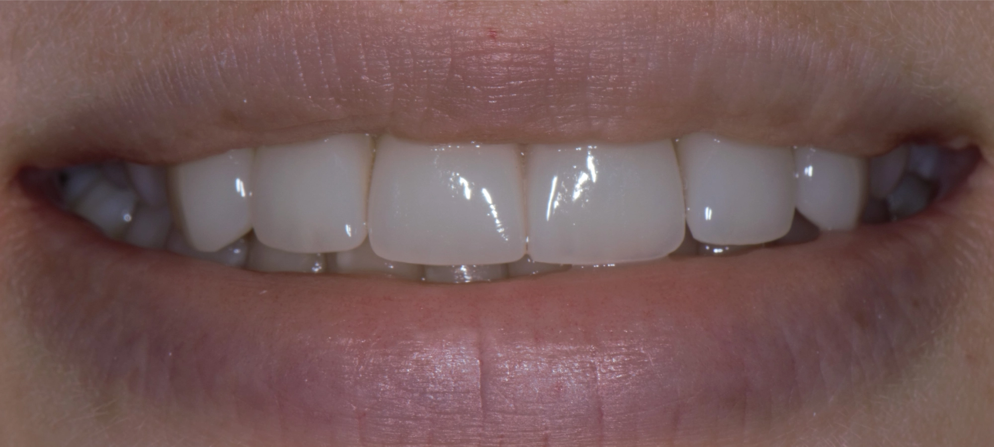veneers after2 veneers after2