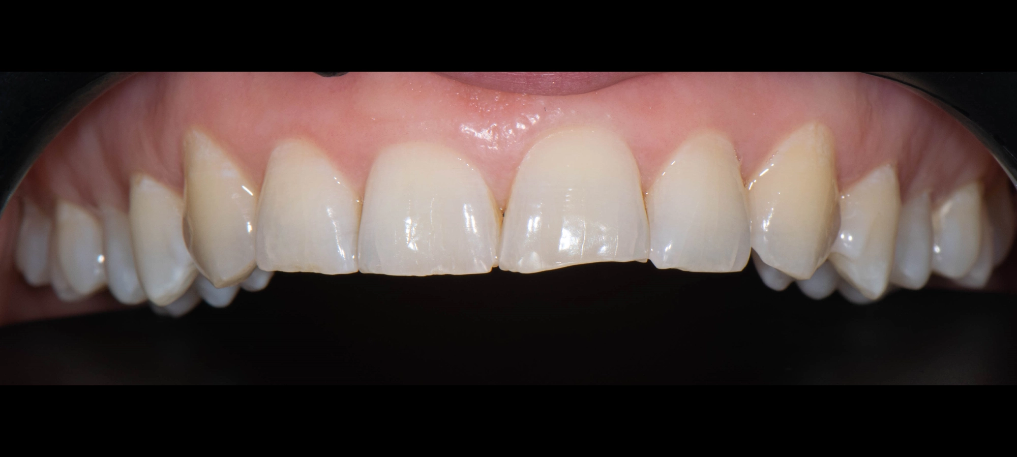 veneers before1 veneers before1